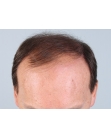 Before Hair Transplant&nbsp;Front